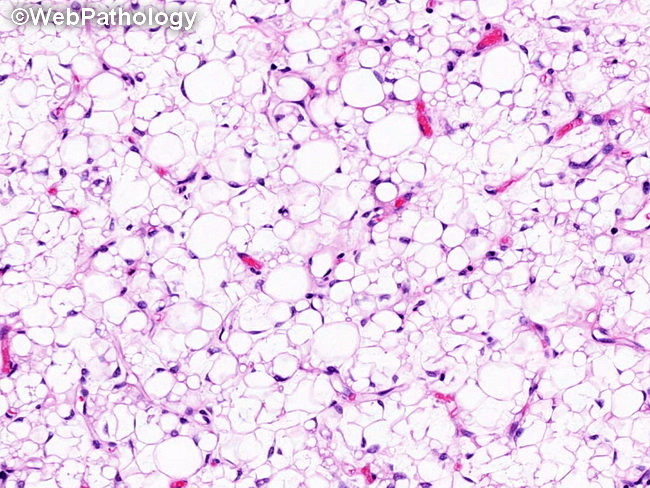 Soft Tissue_Lipomatous_Lipoblastoma36_cropped.jpg